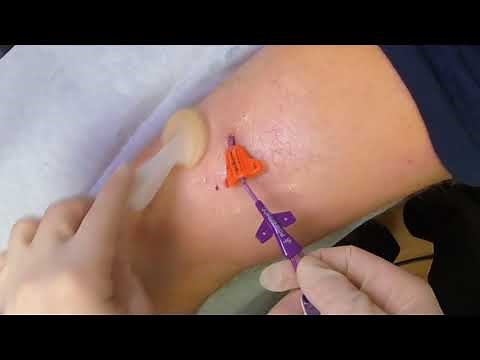 SecurAcath Dressing Change with Biopatch