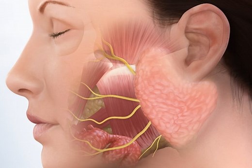 Sialendoscopy for Removal of Salivary Gland Stones - Parotid Tumor Surgery | Salivary Gland Surgery Los Angeles CA