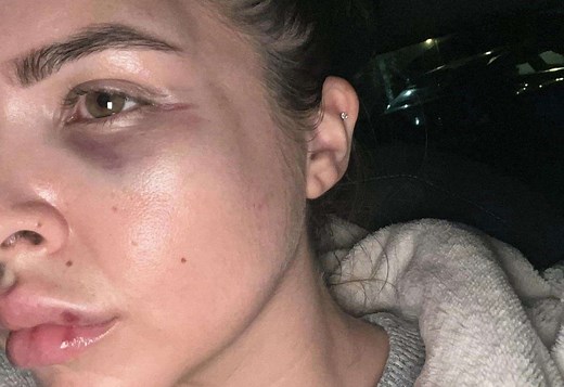 Mum left with broken cheekbone after nightclub attack