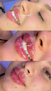 29K views · 233 reactions | Lip filler | Jojo hk | Facebook