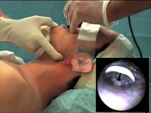 Fiberoptic Bronchoscopic View Before and During the Jaw-Thrust Maneuver