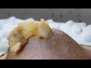 DR LEE’S TLC dr. pimple popper blackheads satisfying cyst removal 0810IPV 0513