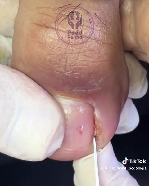 Um cantinho fundo! #unhaencravada #unhas #unhasdecoradas #podologia