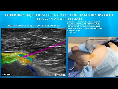 Ultrasound Guided Greater Trochanteric Bursitis Injection by probeultrasound