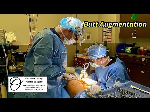 Butt Augmentation | Orange County Plastic Surgery #plasticsurgeon #plasticsurgeryresults