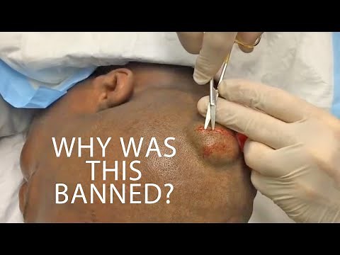 4 Year Old Cyst Removal! Why Was It Banned?