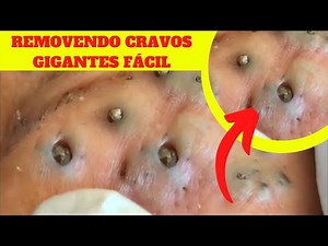 Tirando Cravos e Espinhas Gigantes, Como Remover Cravos em Casa 2020