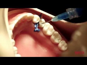 Education Clinical Tips FenderMate® by Directa