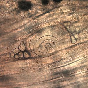 Trichinosis - Alchetron, The Free Social Encyclopedia
