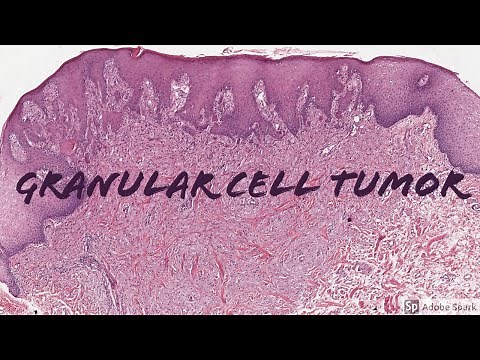 Granular Cell Tumor: 5-Minute Pathology Pearls