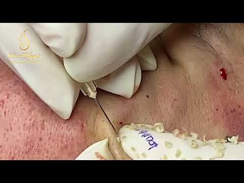 REMOVAL BLACHEADS AND WHITEHEADS (101) | Loan Nguyen