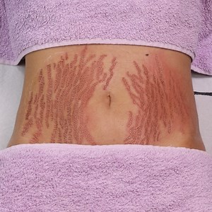 Laser stretch mark removal! | MetDaan