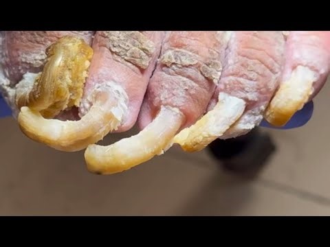 Amazingly Long Toenails, Trimmed One By One[Doctor Liu Pedicure]