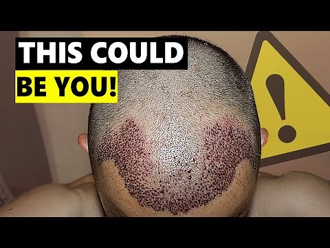5 Things Went Incredibly Wrong with His Hair Transplant!