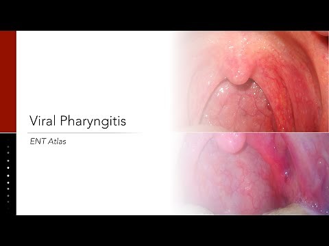 Viral Pharyngitis