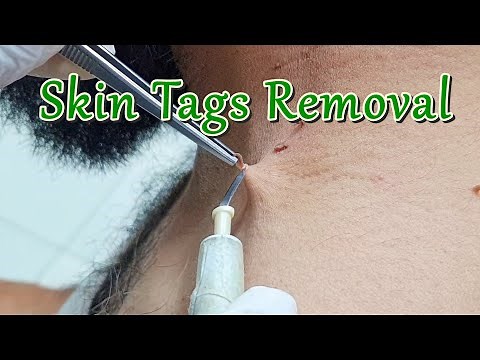 How to Remove Skin Tags around Neck with Electric Cautery | Skin Tag Removal Procedure