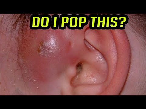 Abscesses, Furuncles & Infections - Do NOT Pop These