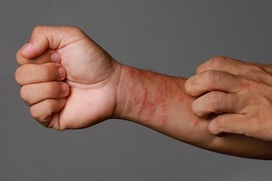 Why are you itchy and how can you stop scratching? New clues revealed