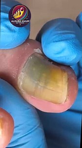 Safe Toenail Cleaning for Sensitive Nail Beds Using Safe At-Home Techniques #WellnessSeniors #FootSupport #FootCareTips | Alishba Anjum vlog