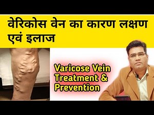 Varicose Vein Cause Symptoms Treatment and Prevention | Varicose Vein Cause Symptoms and Treatment
