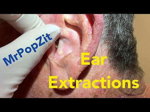 Ear blackhead extractions. Deep filled pockets in the ear concha expressed out.