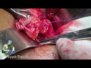 How to apply Purse String Suture to Base of Appendix - Dr Tayyab Riaz Ch