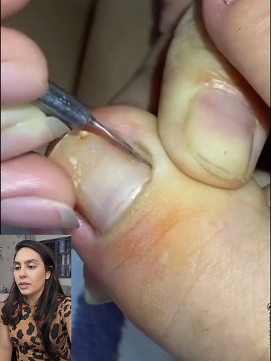 59K views · 733 reactions | Ela tentou desencravar a unha dessa forma! | Manual das Unhas | Facebook