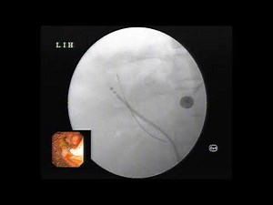 ERCP + HURRICANE BALLOON DILATATION + SEMS INSERTION