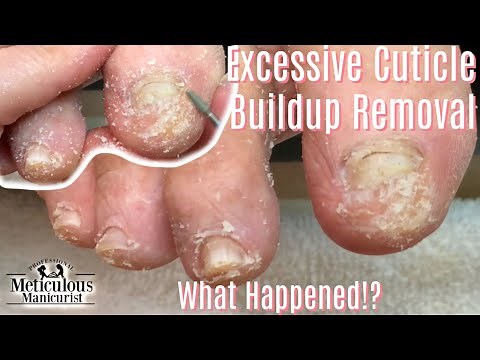 How To Pedicure a Diabetic Foot Tutorial and Tips Follow Up Part 1