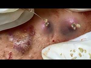 Big Cystic Acne Blackheads Extraction Blackheads & Milia, Whiteheads Removal Pimple Popping