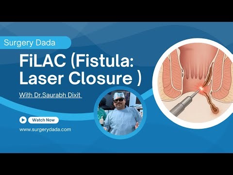 FILAC for Fistula-in-Ano | Laser-Guided Minimally Invasive Surgery | Surgery Dada
