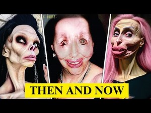 25 Celebrities Before and After Plastic Surgery