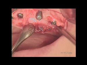 Ridge augmentation, followed by immediate implant placement at challenging site