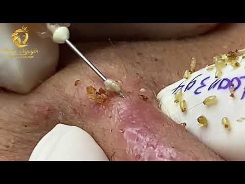Treatment of blackheads and whiteheads (394) | Loan Nguyen