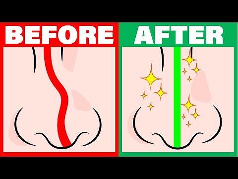 How to improve your breathing if you have a deviated septum