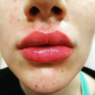 "WOW" Lip Augmentation with Juvederm Voluma! By Dr. Lebowitz, Long Island, New York.