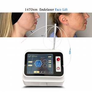 [Hot Item] 1470nm Diode Laser Lipolysis Weight Loss Endolaser Lifting Facial Lipolysis Liposuction Machine with Fiber