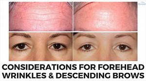 Considerations for Botox in the Forehead Affecting the Brows