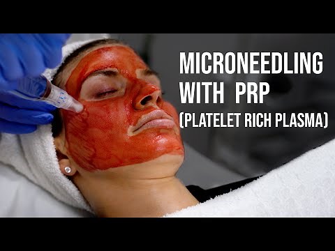 Microneedling with PRP (Platelet Rich Plasma)- Renee Tucker, Aesthetician | West End Plastic Surgery