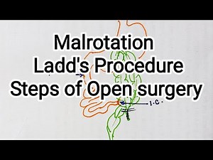 Malrotation, Ladd's Procedure