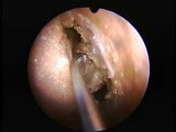 Anterior Ethmoidectomy - Endoscopy • Video • MEDtube.net