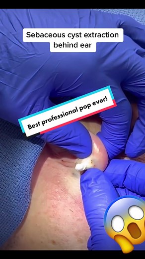 Never ending sebaceous cyst removal. #oddlysatisfying #satisfyingvideos #pimpletiktok #extractions #cystpopping #sebaceouscyst #pimplepoppingheaven