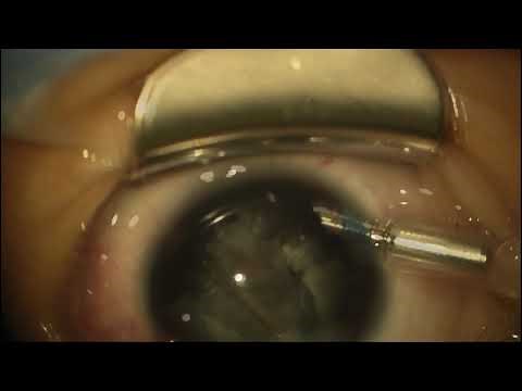 Surgery: Cataract Surgery in a Young Child: Vitrector Technique: Dr. Daniel Neely
