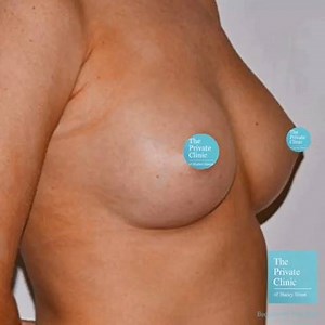 At The Private Clinic, we work with highly skilled plastic surgeons who have performed many breast augmentations with great results. You can meet our specialised breast surgeons at any of our clinics: London, Birmingham, Manchester, Leeds, Glasgow, Buckinghamshire, Northampton, Bristol and Essex. To book call us on: 03300573766 | The Private Clinic of Harley Street