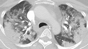 Scan shows how viciously Covid attacks the lungs