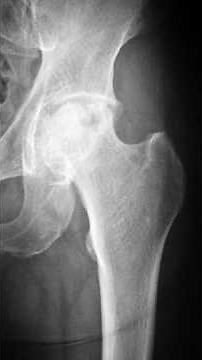 AVN of Hip: The SIMPLE Explanation You Need! ✅🦵