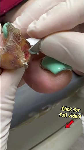Oddly Satisfying Deep Ulcer Debridement | Diabetic Foot