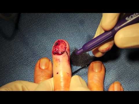 Live Surgery. Completion of Distal Finger Amputation for Cancer.m4v