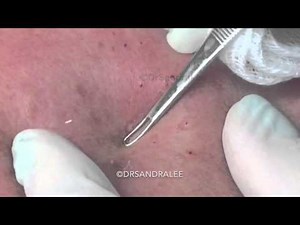 Whiteheads and milia- comparing two women of differing ages. For medical education- NSFE.