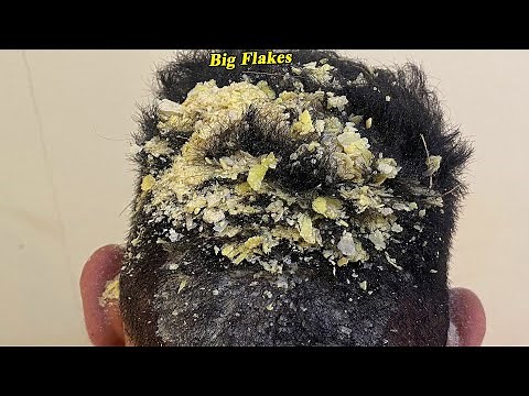 DRY SCALP !! Big Flakes Dandruff Scratching Satisfying Video #807